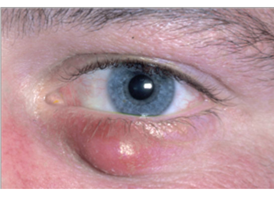 Eyelid cyst requiring incision and curettage with local anaesthetic