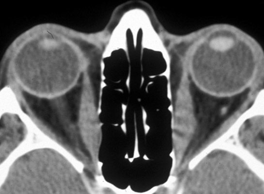 CT showing swelling of the (inner) medial recti muscles