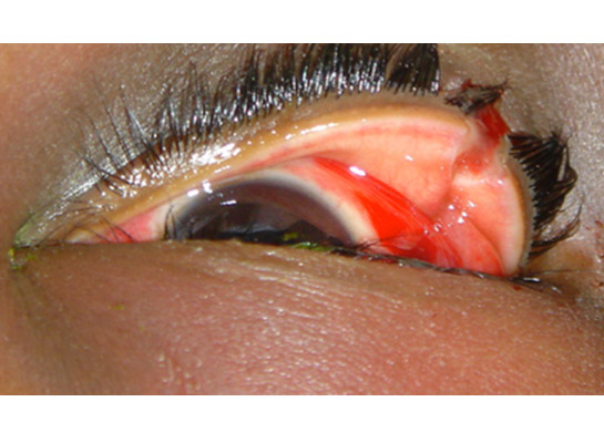 Laceration across the upper eyelid requiring repair