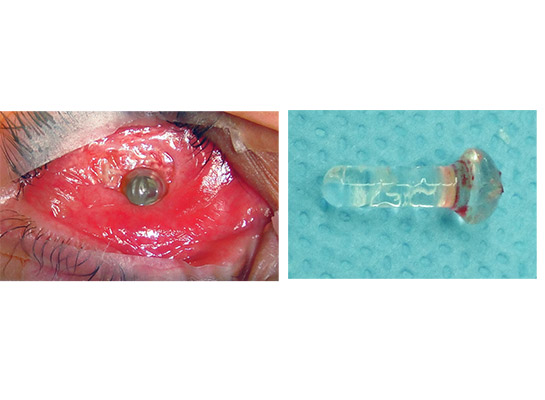 Patient referred from elsewhere with an infected pegged implant requiring removal and exchange with deeper orbital implant. Peg after removal (Right)