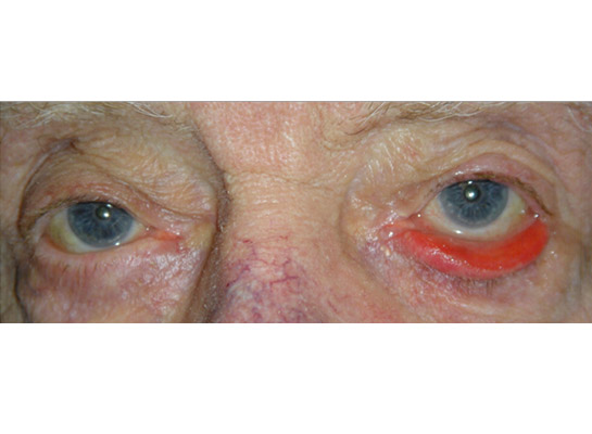 Ectropion (out-turning) of the lower eyelid with redness and watering