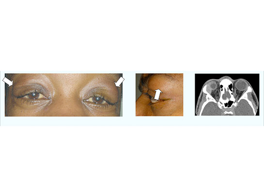 Lacrimal gland enlargement (arrow) with CT imaging showing enlarged gland on left