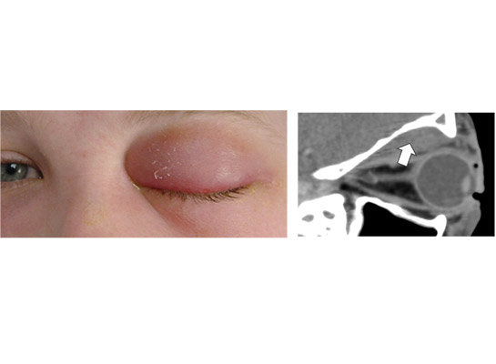 Infective orbital cellulitis, with CT showing sinusitis and orbital abscess (subsequently drained)