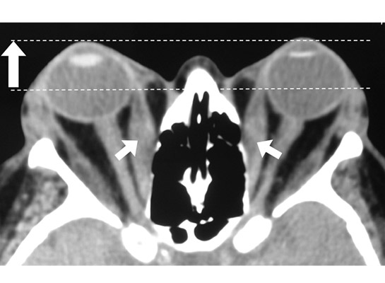TED with CT scan showing forward displacement of the eyes (long arrow) and enlarged muscles (short arrows)