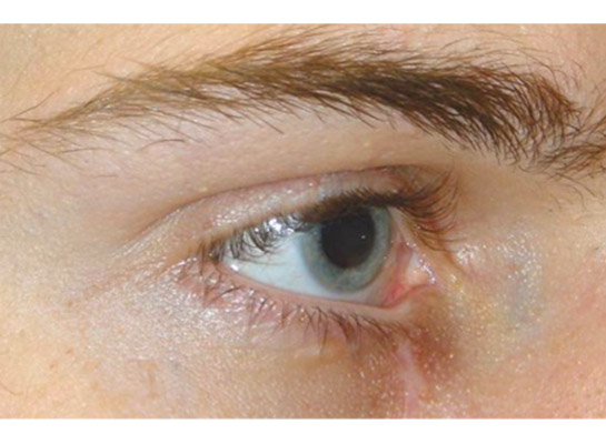 Previous injury to lower lid leading to ectropion and watering