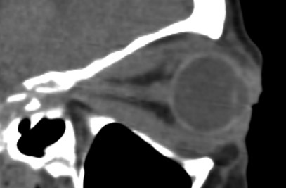 CT scan showing proptosis and muscle enlargement in severe TED.