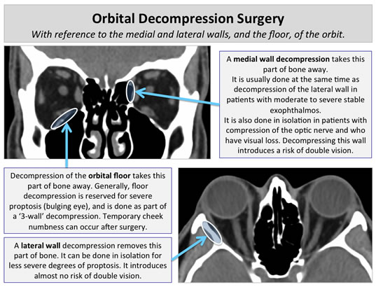 orbital-decompression-surgery-2s